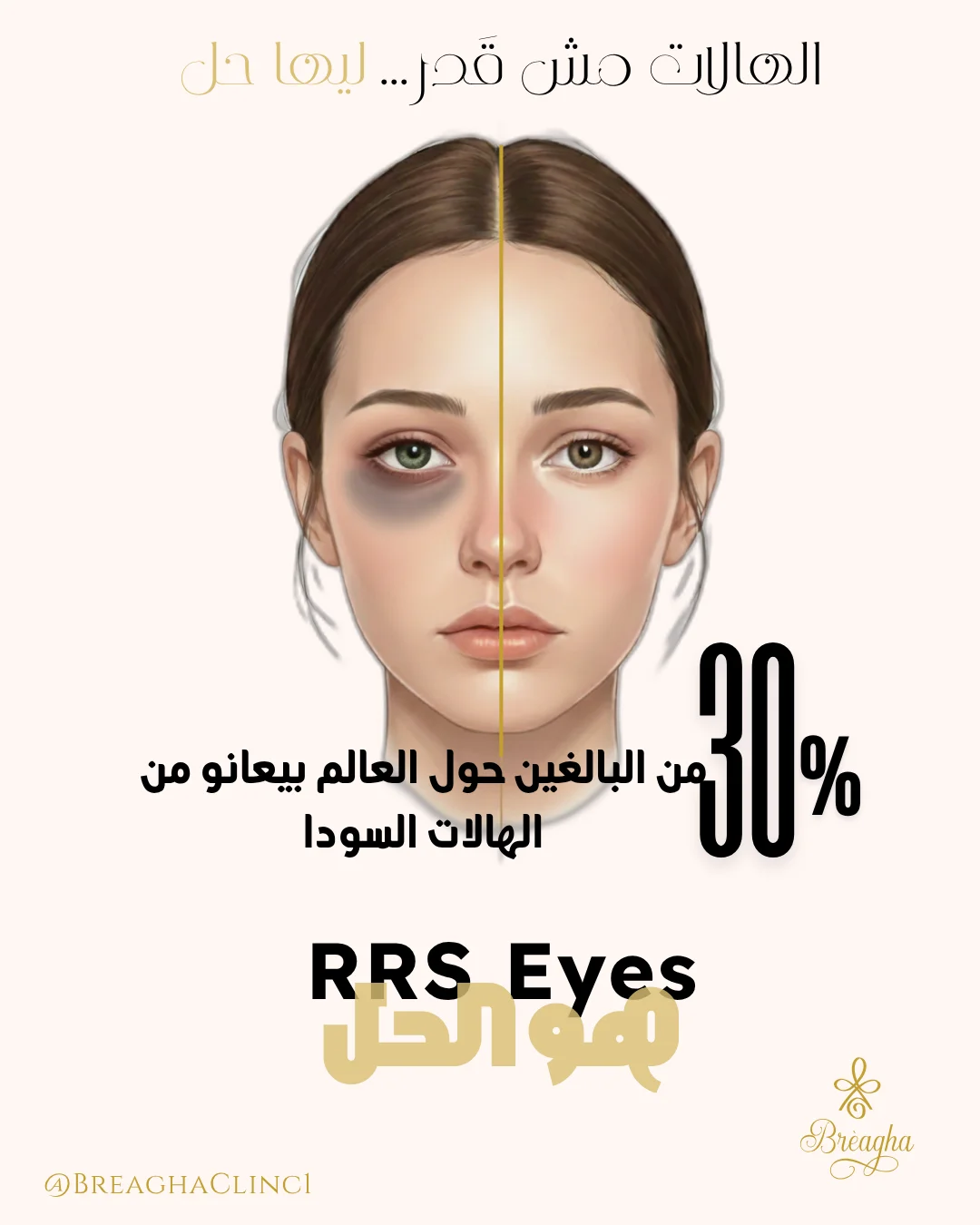 علاج الهالات السوداء تحت العين - عيادة براجيا للتجميل والليزر